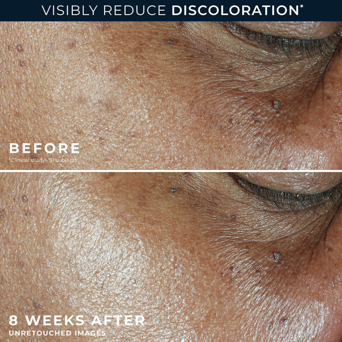 MULTI CORREXION® Even Tone + Lift Daily Moisturizer SPF 30 Before and after of participants' cheek showing visible reduction in uneven skin tone