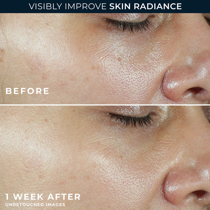Before and After Image of clinical study participant showing improvement in the texture of skin on cheek after using MULTI CORREXION® Revive + Glow Moisturizer SPF 30 for 1 week.