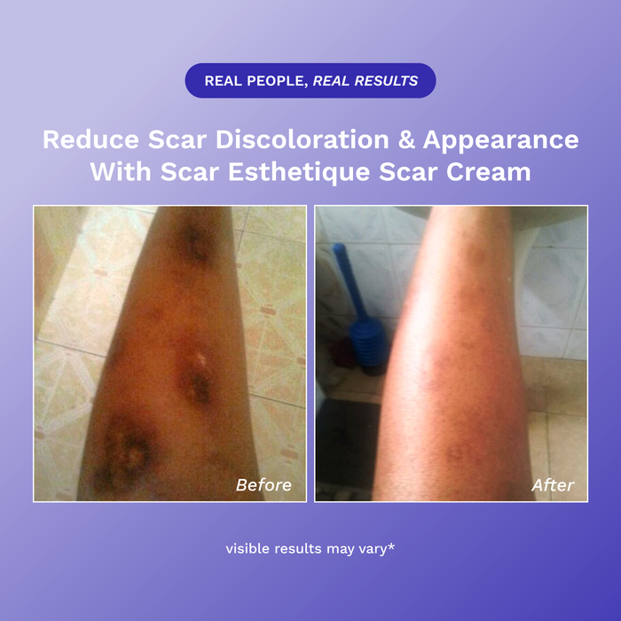 Scar Esthetique Scar Cream product image 5