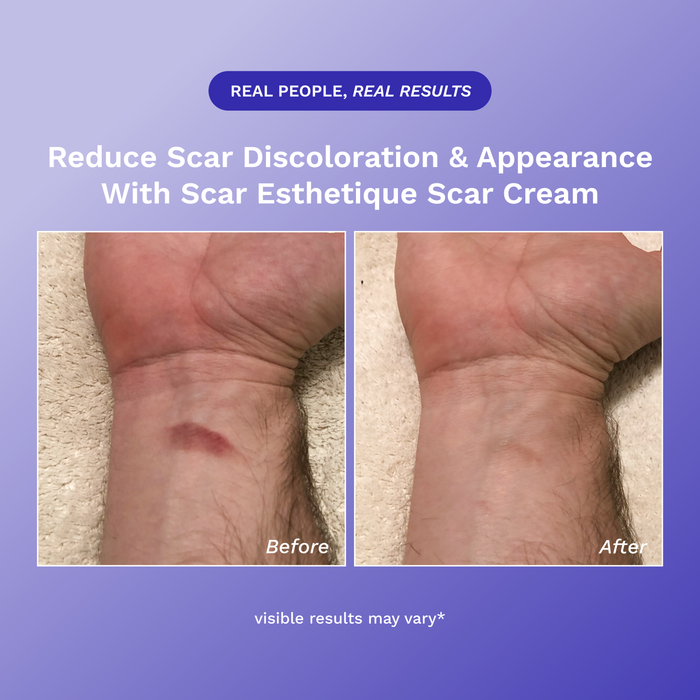 Scar Esthetique Scar Cream product image 6