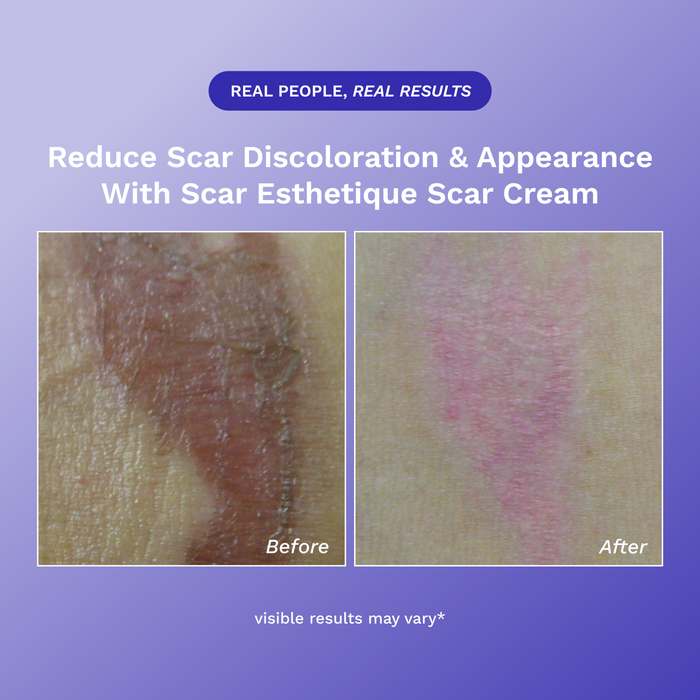 Scar Esthetique Scar Cream product image 7